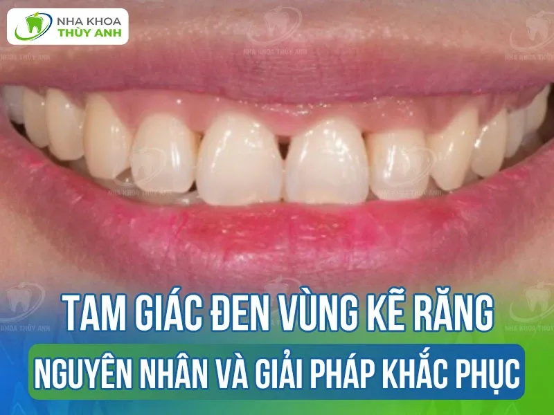 Hinh anh minh hoa tam giac can voi day, chieu cao, canh ben